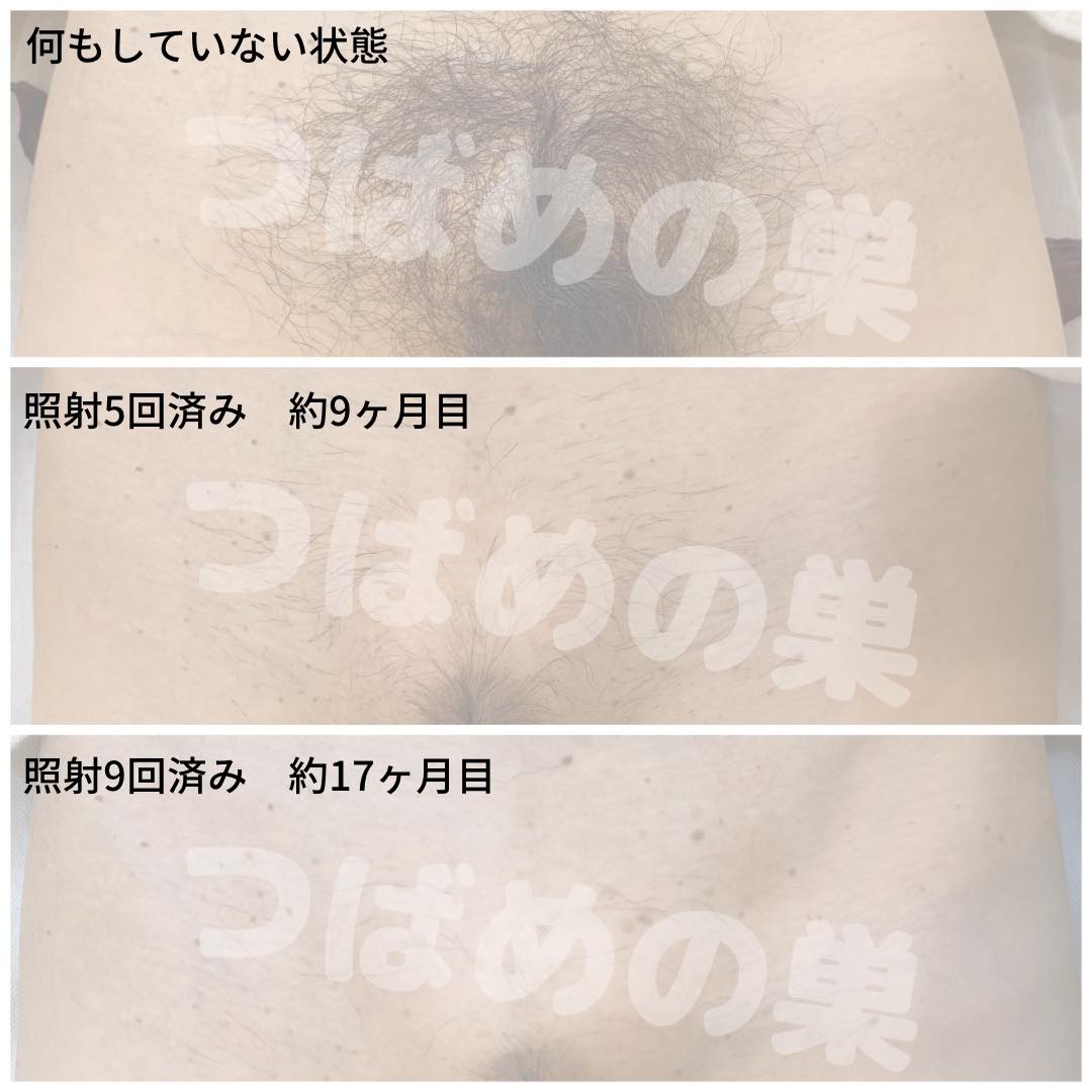 vio 脱毛 写真 女性